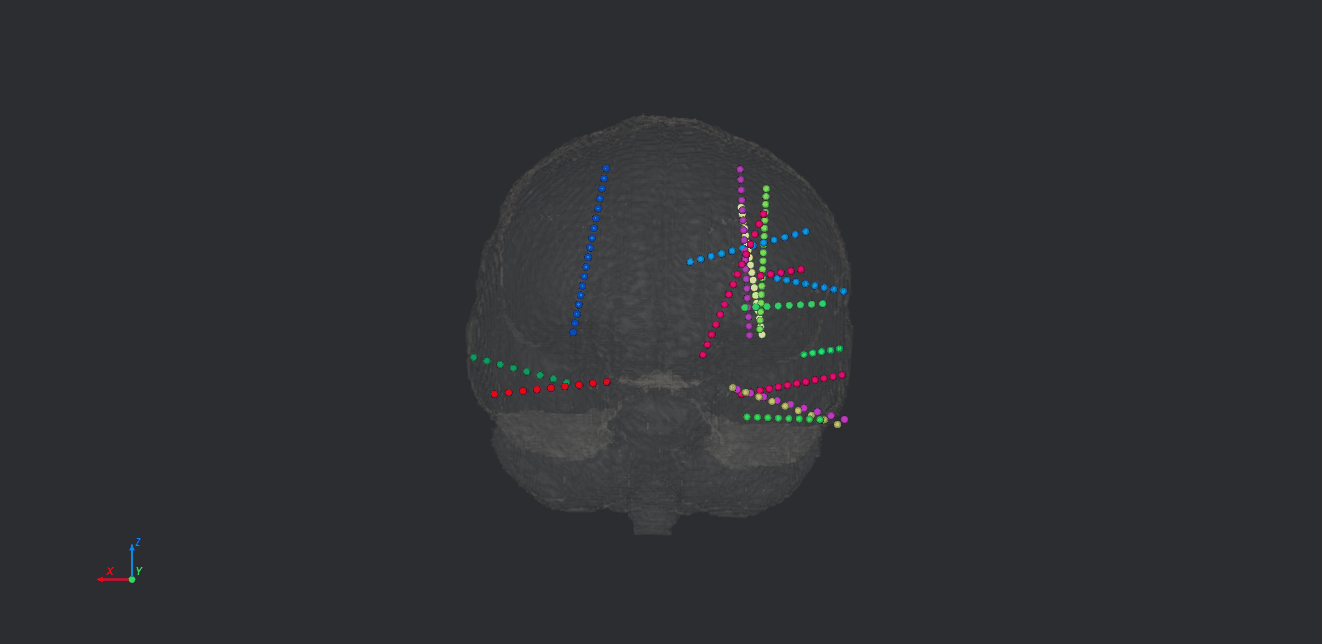 Electrodes on brain