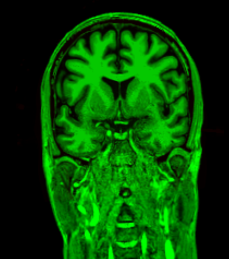 T1 MRI