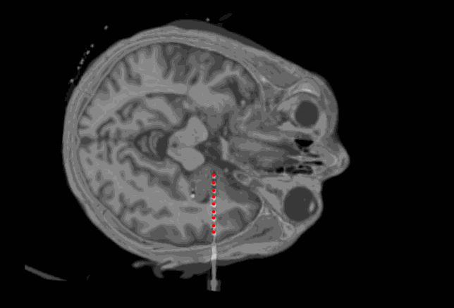 Oblique + CT