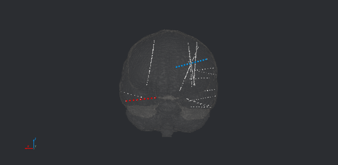 SEEG electrodes in 3D